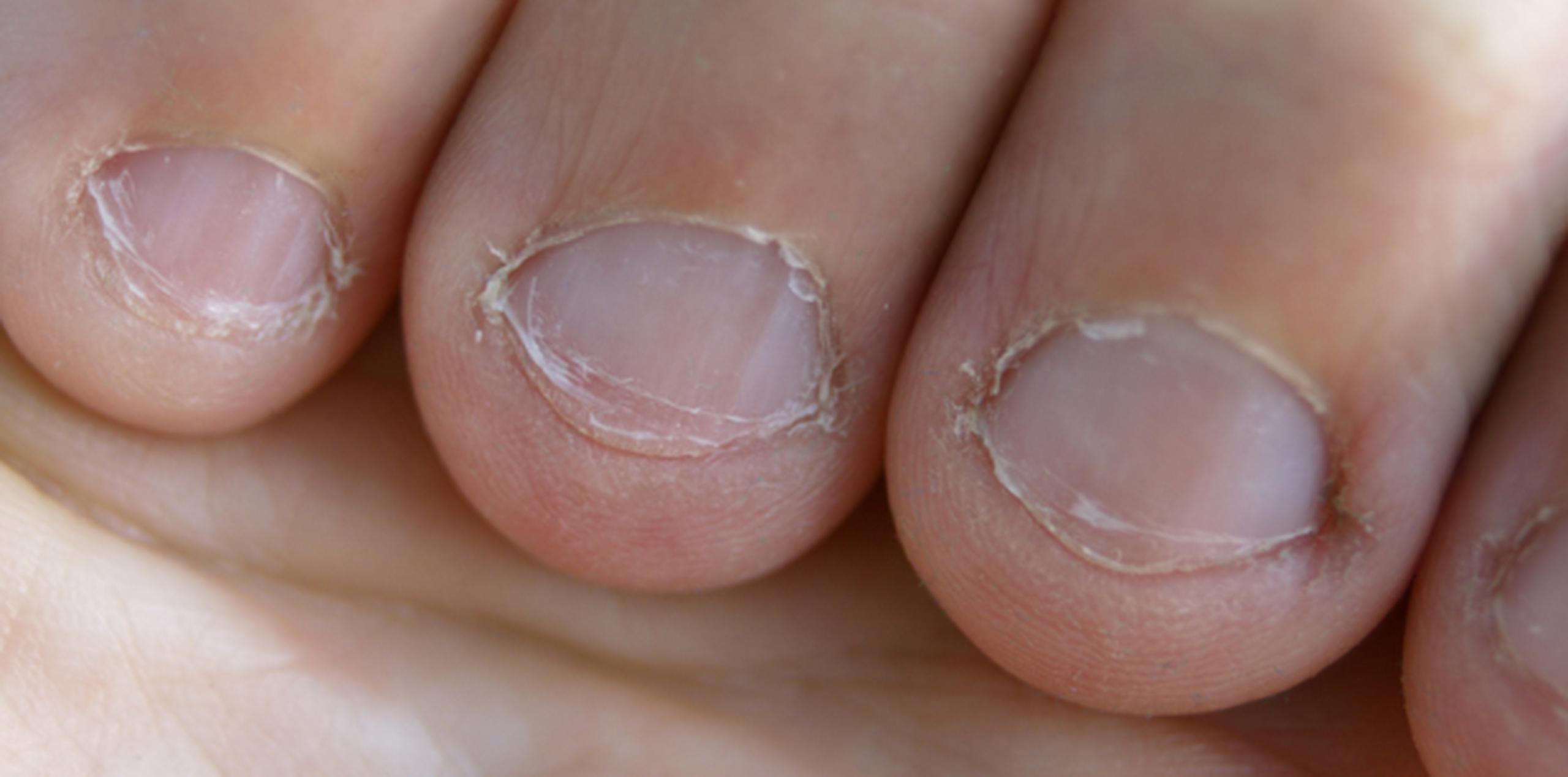 Comerse la piel de alrededor de las uñas tiene riesgos mortales. (Shutterstock)