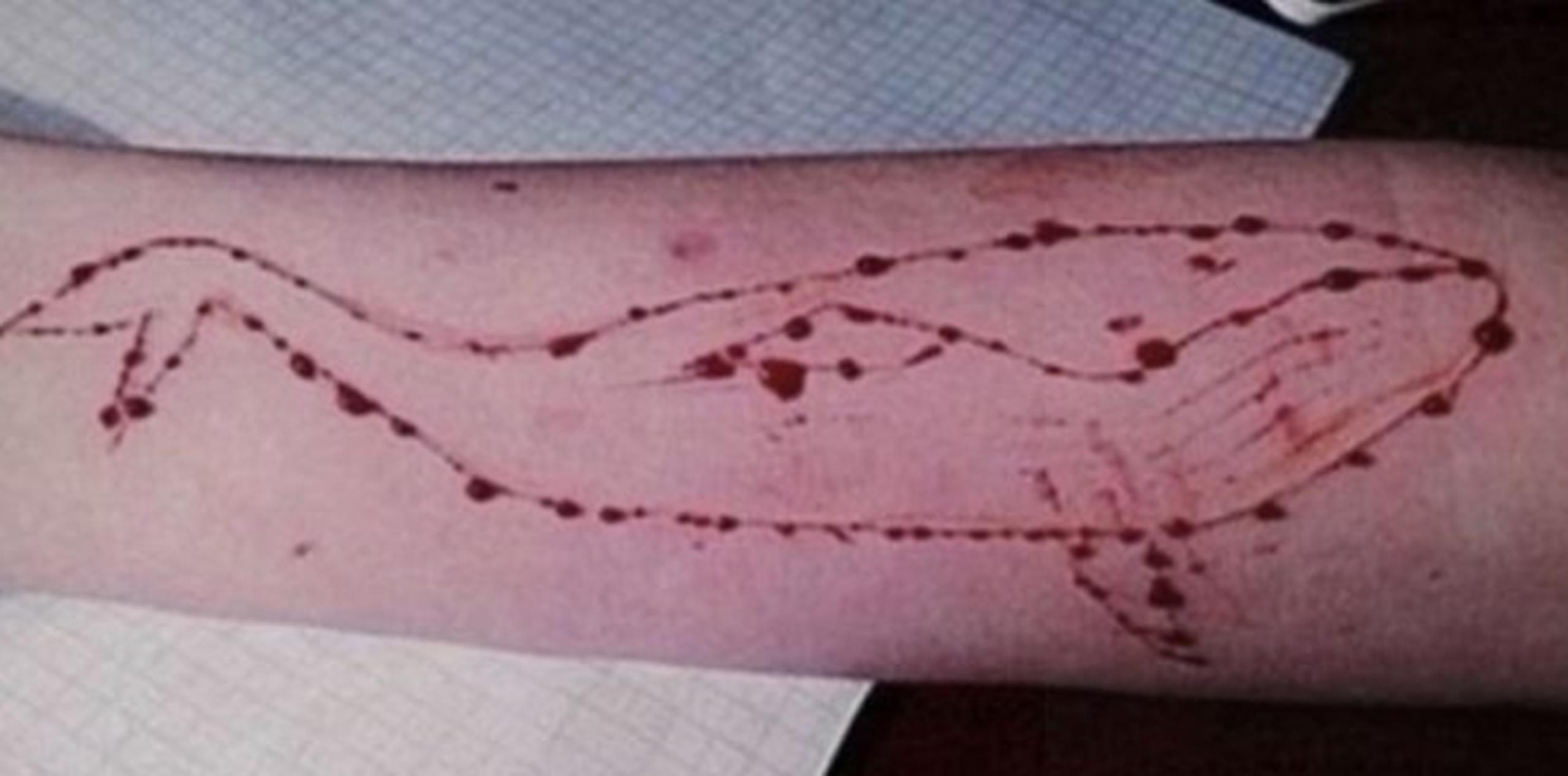 Como parte del reto, adolescentes marcan una ballena azul en su piel con un cuchillo. (El Nacional)