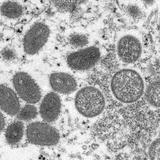 Asesor de la OMS vincula brote de viruela a dos recientes fiestas masivas en España y Bélgica