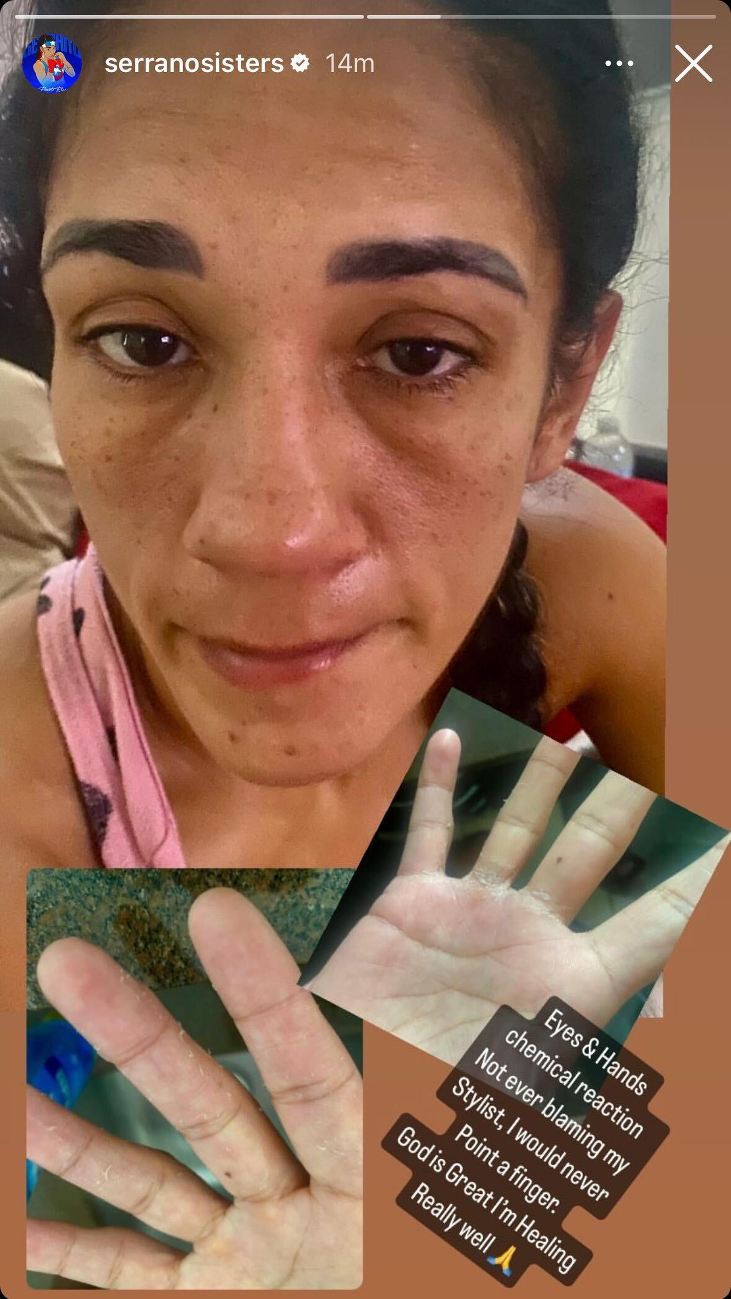 Amanda Serrano muestra los ojos y manos por una presunta reacción química.