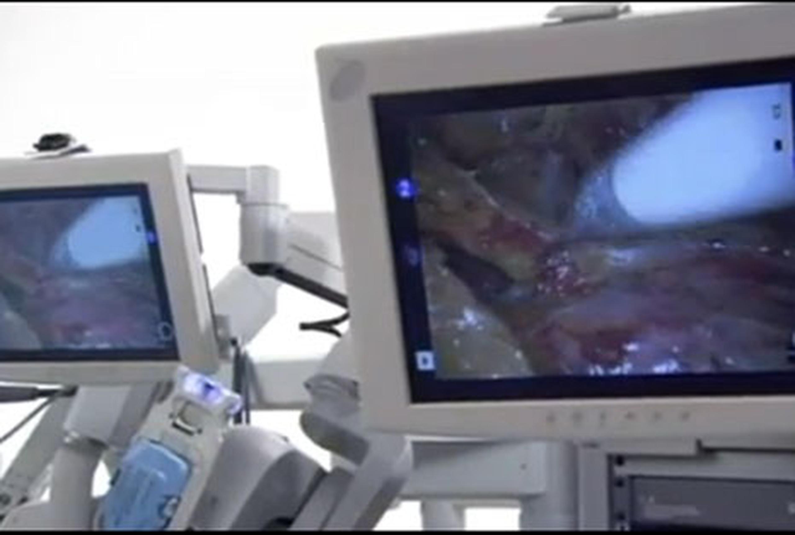 La cirugía robótica es un procedimiento de laparoscopia, que se practica a través de pequeñas incisiones bajo una cámara de vídeo que permite ver el campo de intervención del paciente en tres dimensiones y actuar sobre él con tres brazos mecánicos articulados y dirigidos por el médico desde la distancia. (EFE)