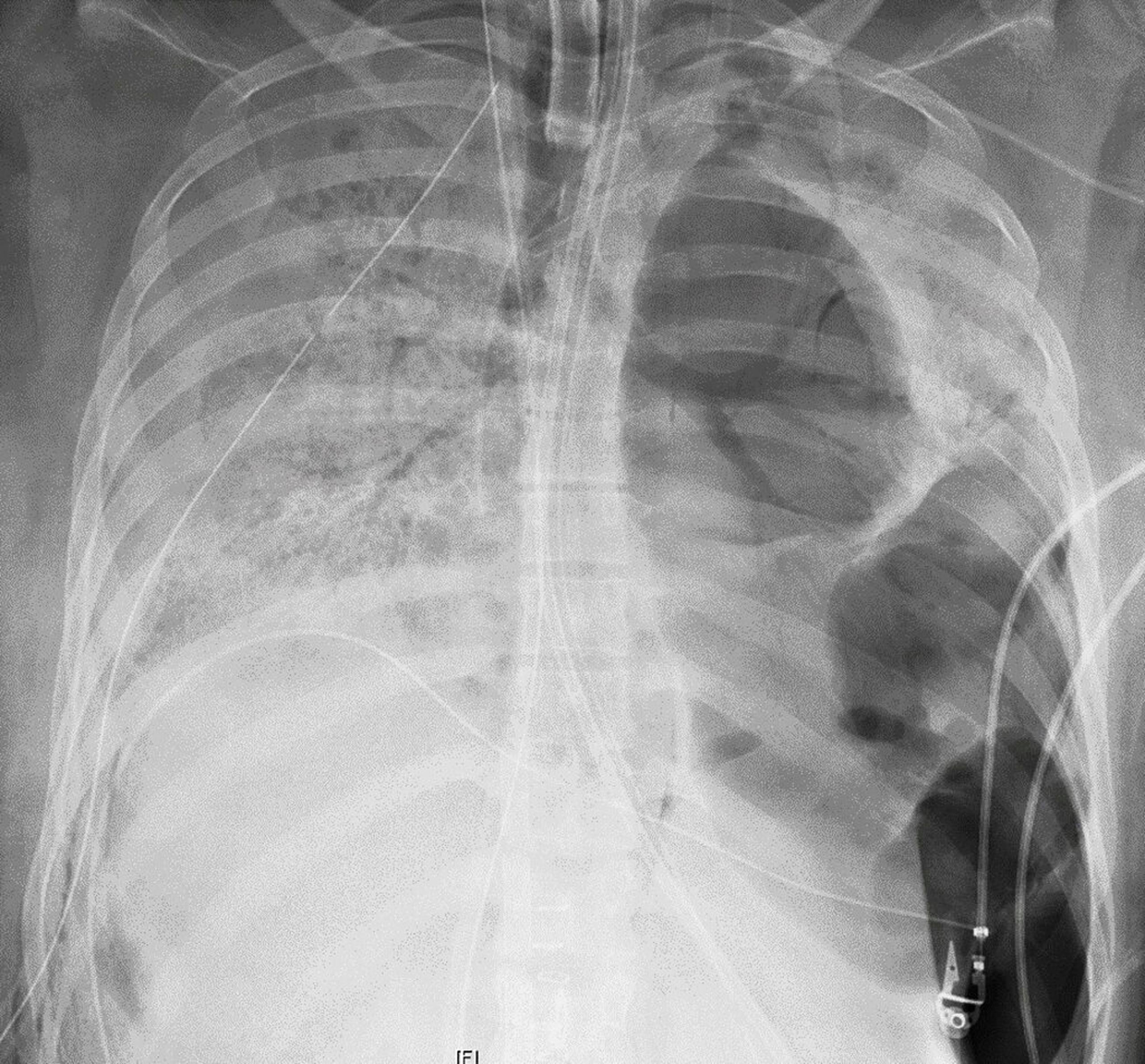 Imagen de rayos X de los pulmones de la paciente antes de recibir el trasplante en el Hospital Northwestern Memorial.