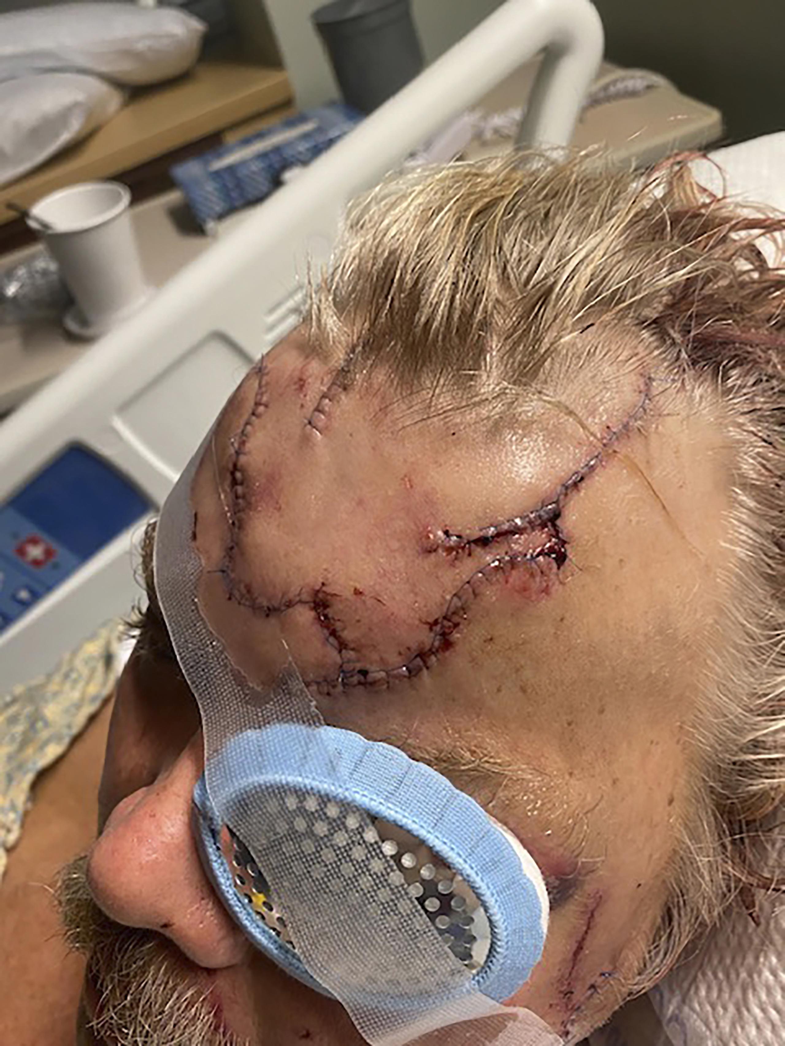 Lesiones en la cabeza de Allen Minish mientras se recupera en un hospital de Anchorage, Alaska, tras ser atacado por un oso pardo.